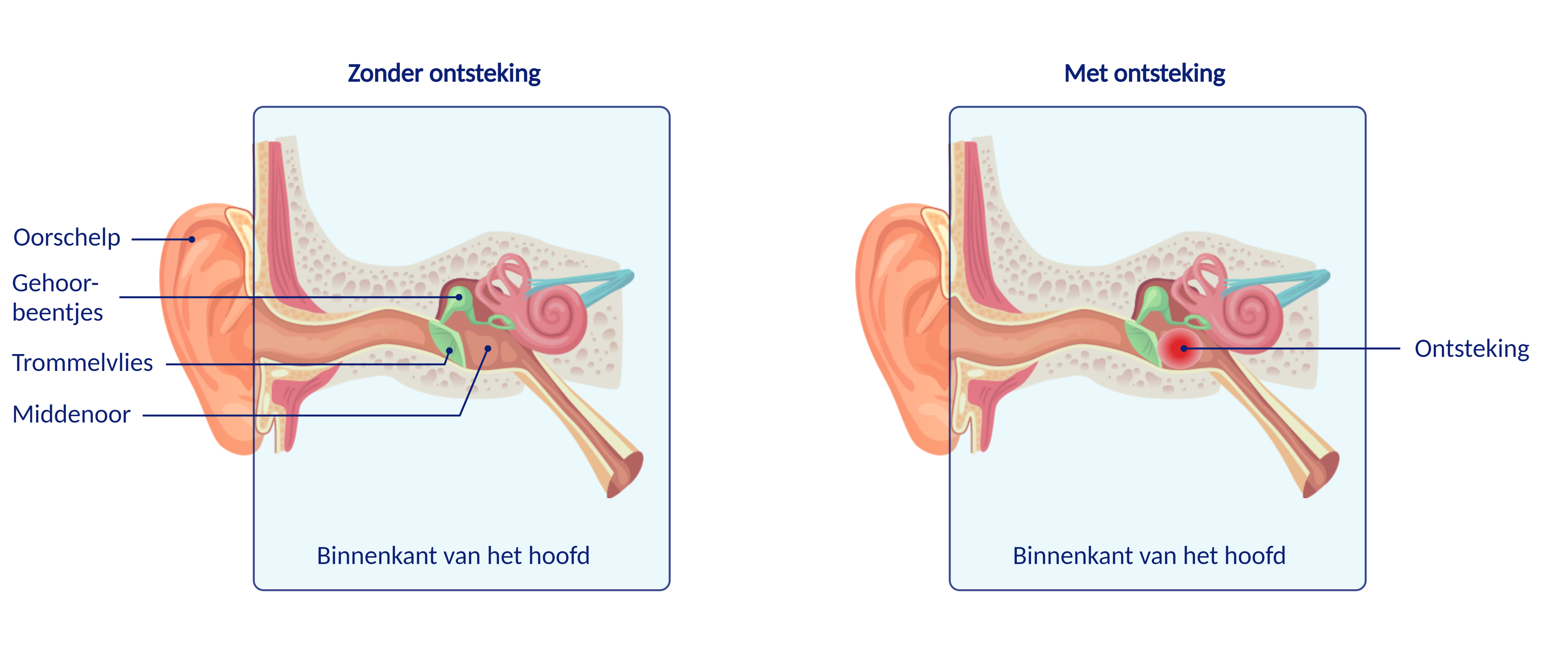 Operatie: verwijderen ontsteking in het oor - Patiëntenfolder - Erasmus MC